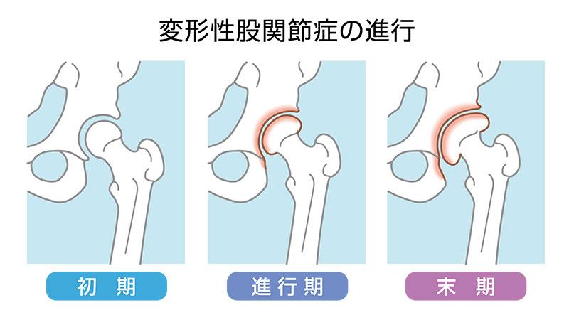 変形性股関節症