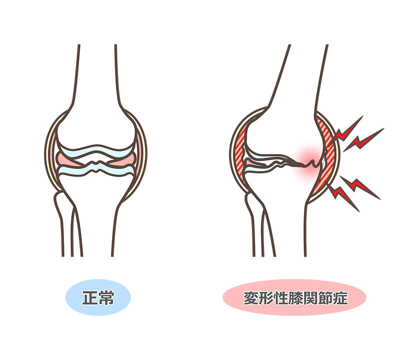 変形性膝関節症